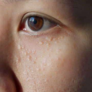 MEOD Beauty & Aesthetics Blog - Syringomas