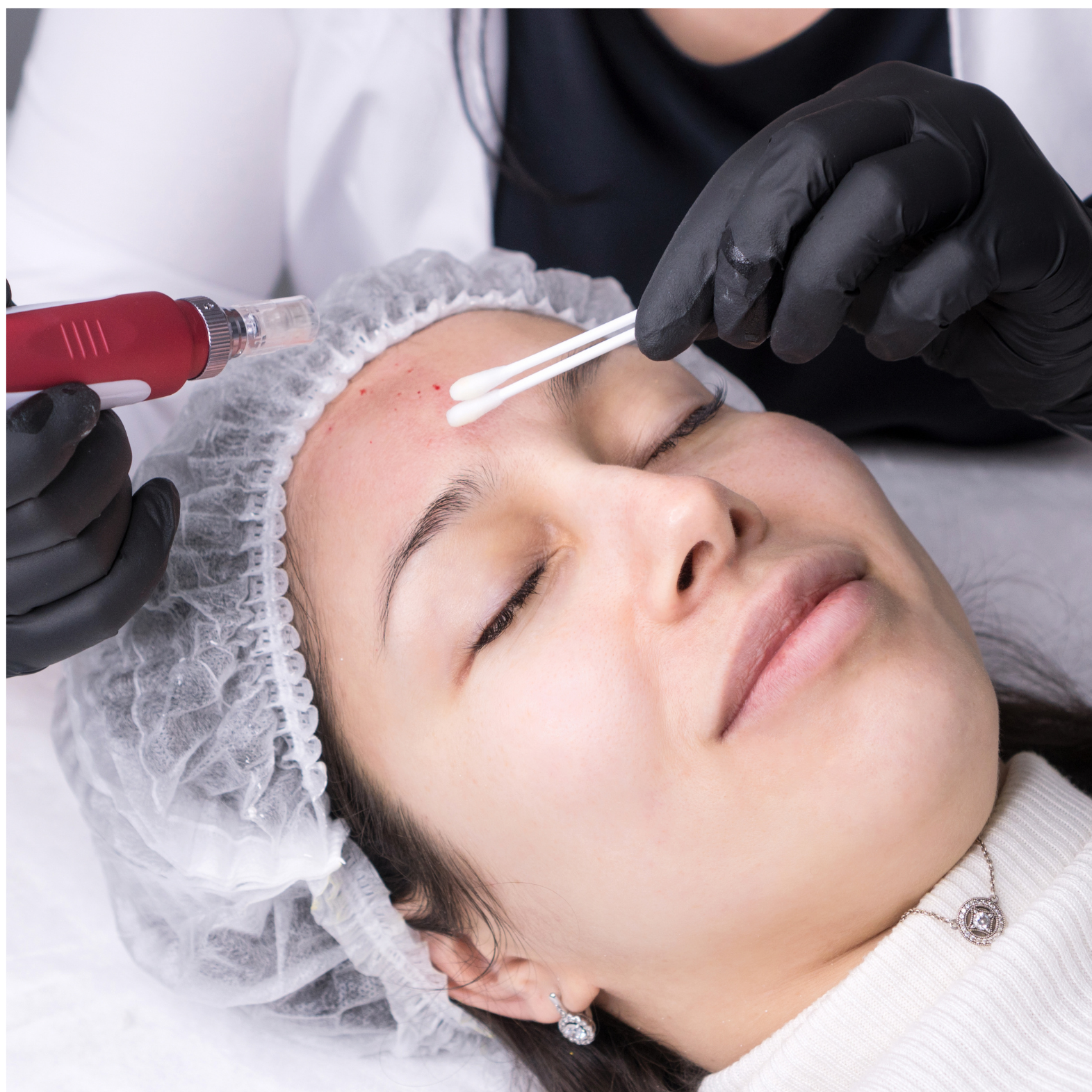 MEOD Beauty & Aesthetics - Micro-Needling Facial