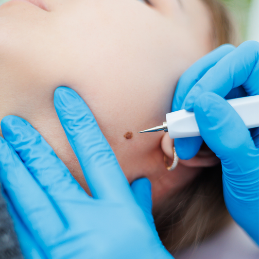MEOD Beauty & Aesthetics - Other Treatments - Skin Tag Mole Removal